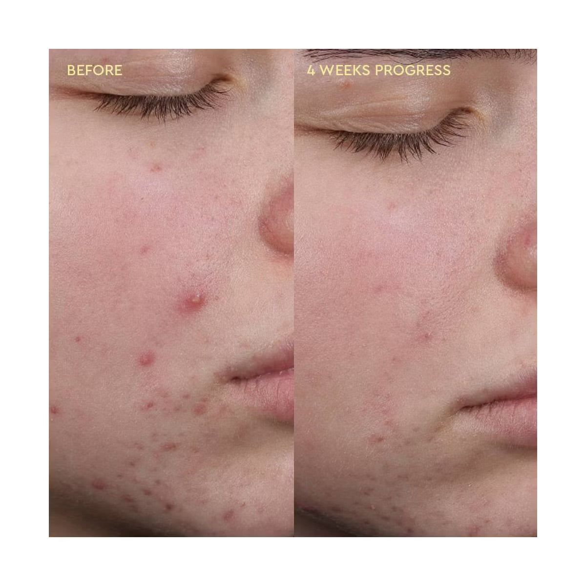 Byoma Blemish Acne Clearing Creamy Cleanser - 175ml