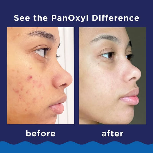 PanOxyl Maximum Strength Antimicrobial Acne Foaming Wash for Face and Body 1oz